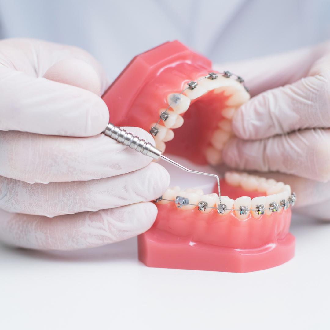 Ortodoncia personalizada