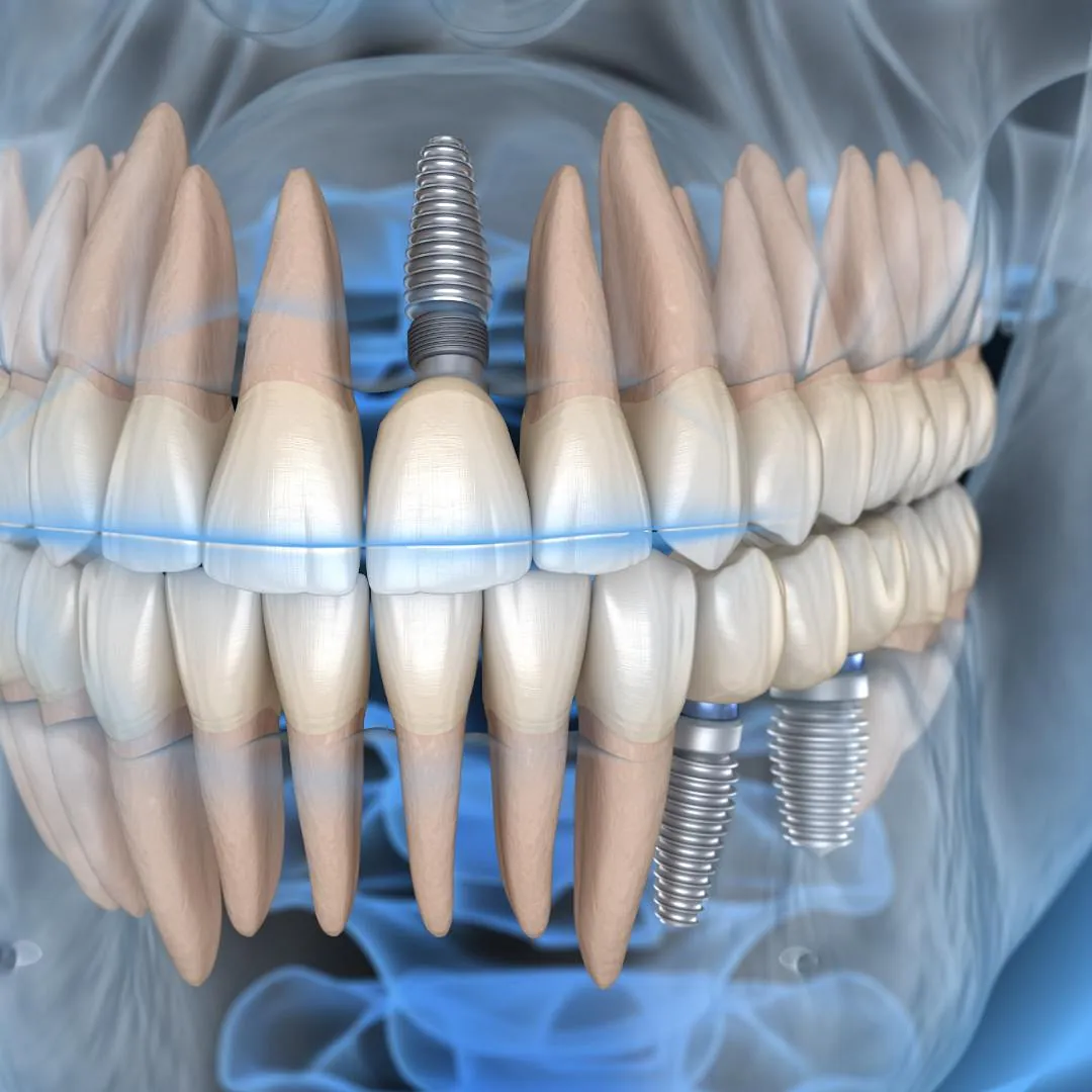 implante dental
